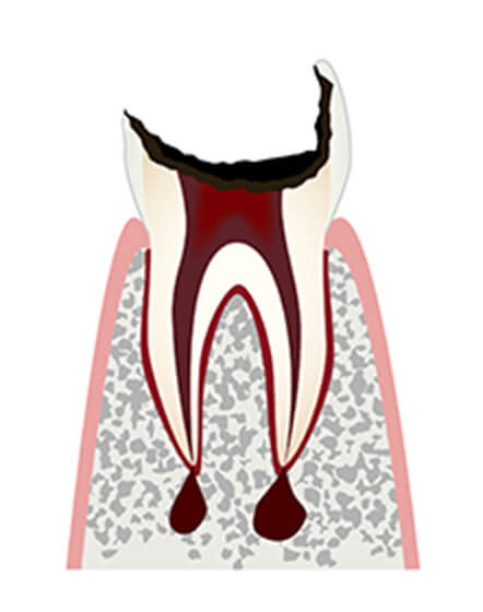 【C4】歯根まで達した虫歯